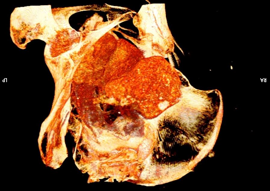 Imagen de tomografía del feto.